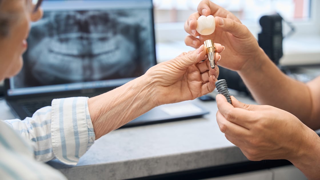 Implant photo
