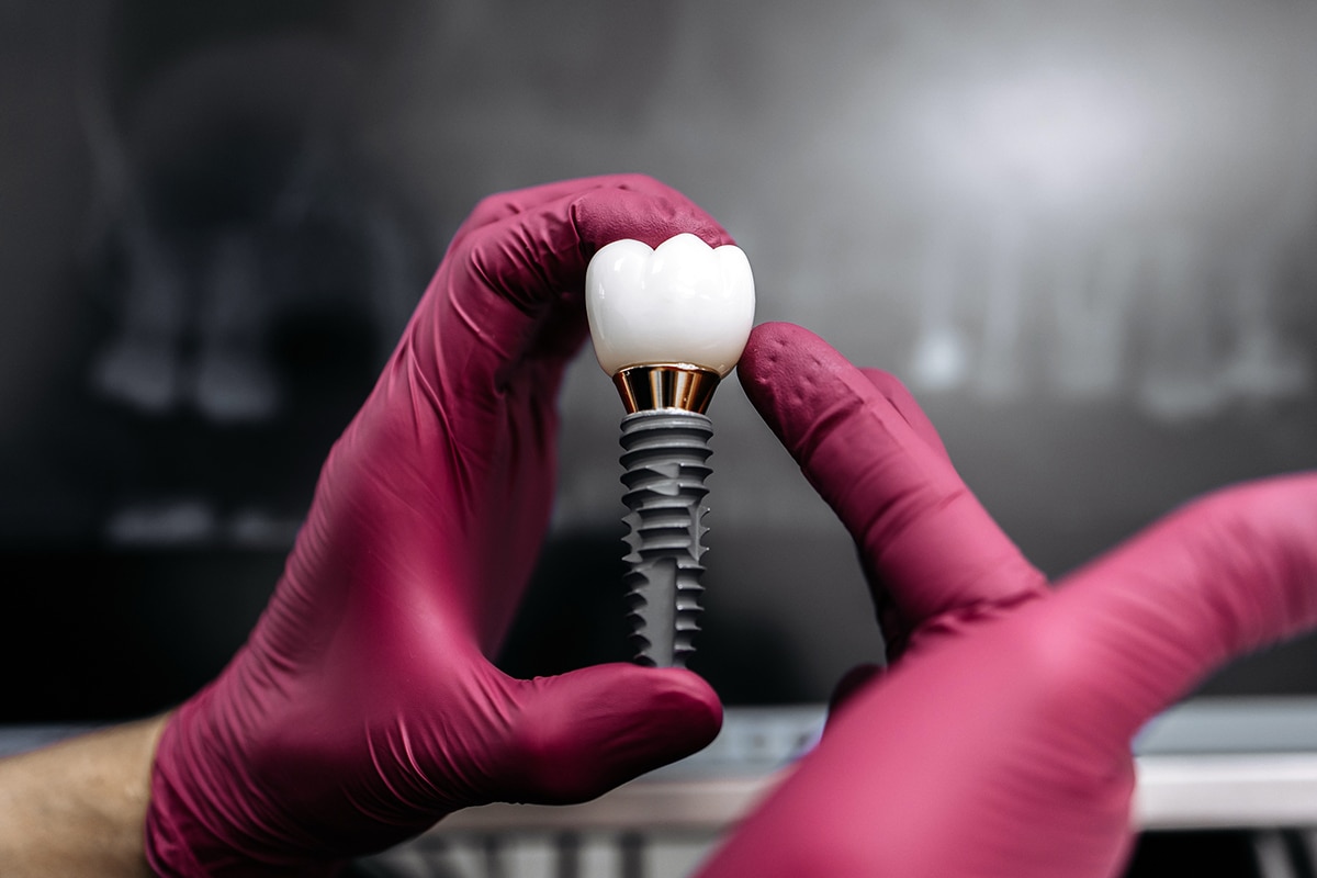Single tooth implants vs bridges pros and cons explained blog